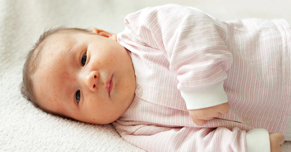 Nguyên nhân gây mụn sữa ở trẻ sơ sinh và cách xử lý